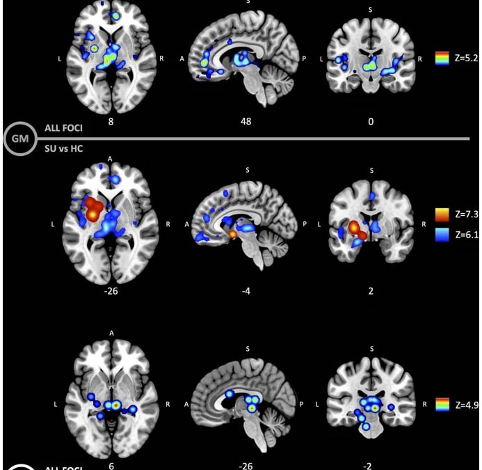Gray and white matter morphology in substance use disorders: a neuroimaging systematic review and meta-analysis