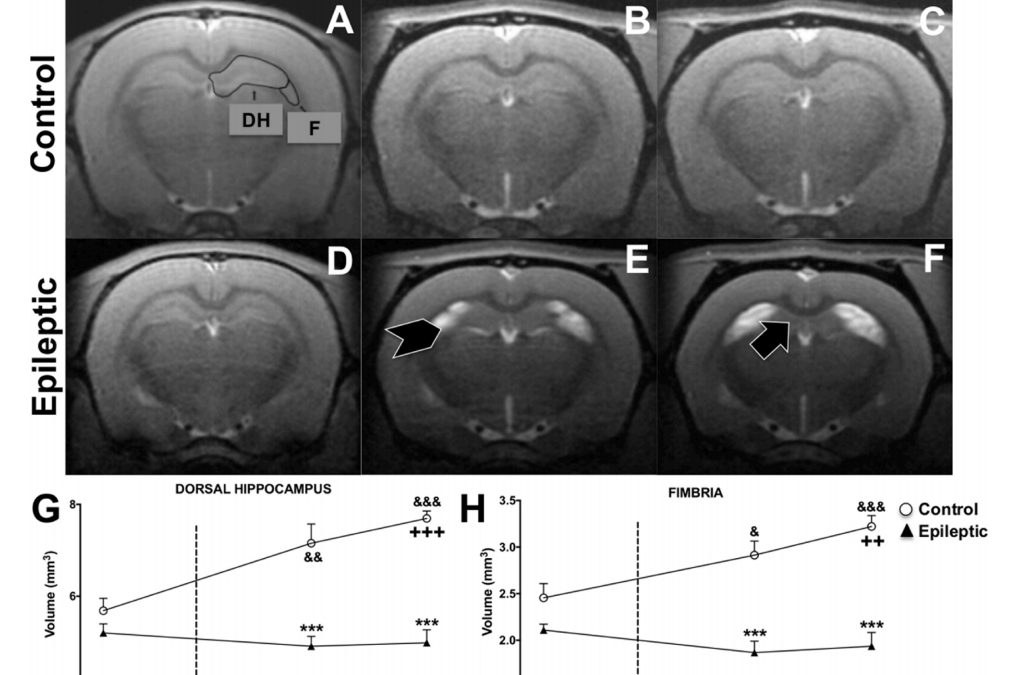 Longitudinal changes in gray and white matter microstructure during epileptogenesis in pilocarpine-induced epileptic rats