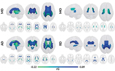 Evidence of Genetic Overlap Between Circadian Preference and Brain White Matter Microstructure